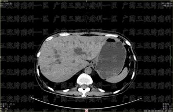 胰腺癌患者转院前，被医生宣判活不过三个月