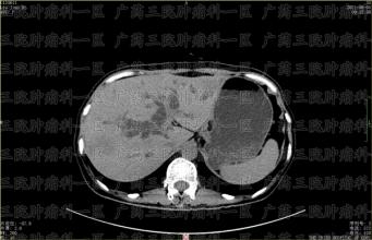 胃溃疡和胃炎是现代人的常见病之一